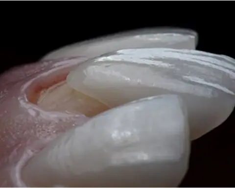 High-Aesthetic Dental Veneers