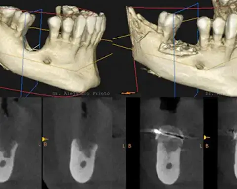 Bone Regeneration