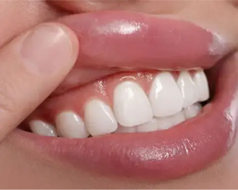 Receding Gums Treatment
