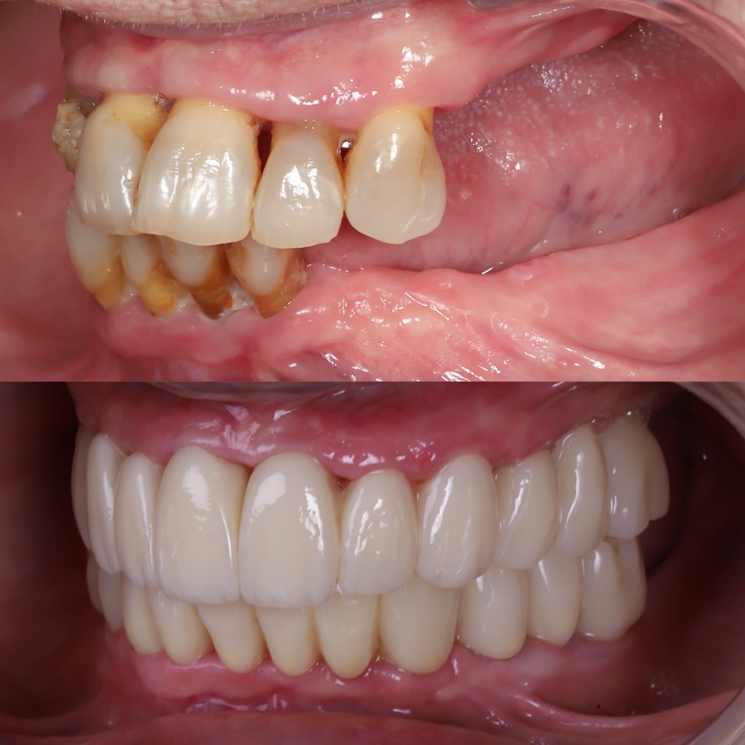 Screwless implant treatment