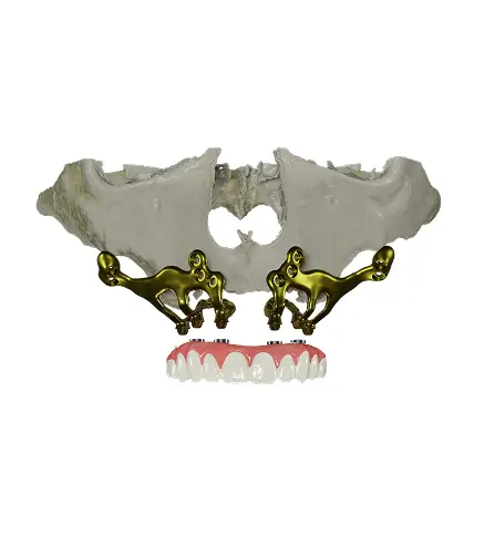 Subperiosteal dental implants