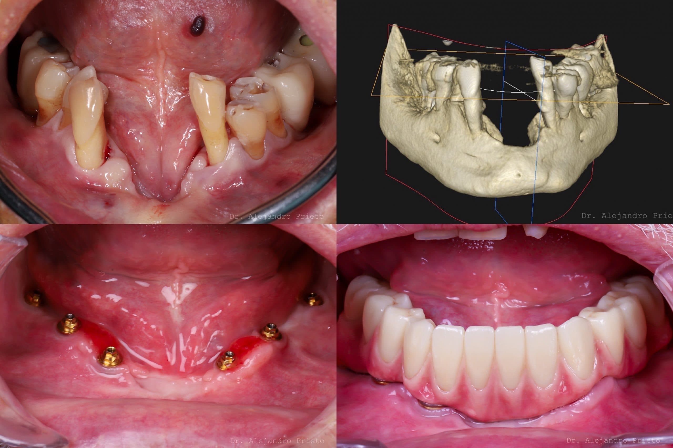 Screwless dental implant result