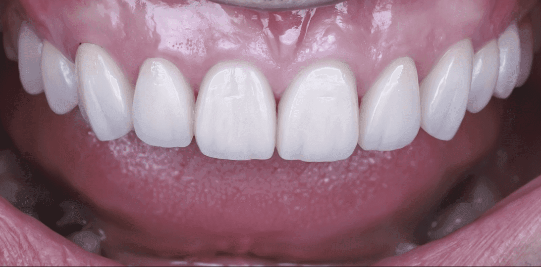 Porcelain Veneers