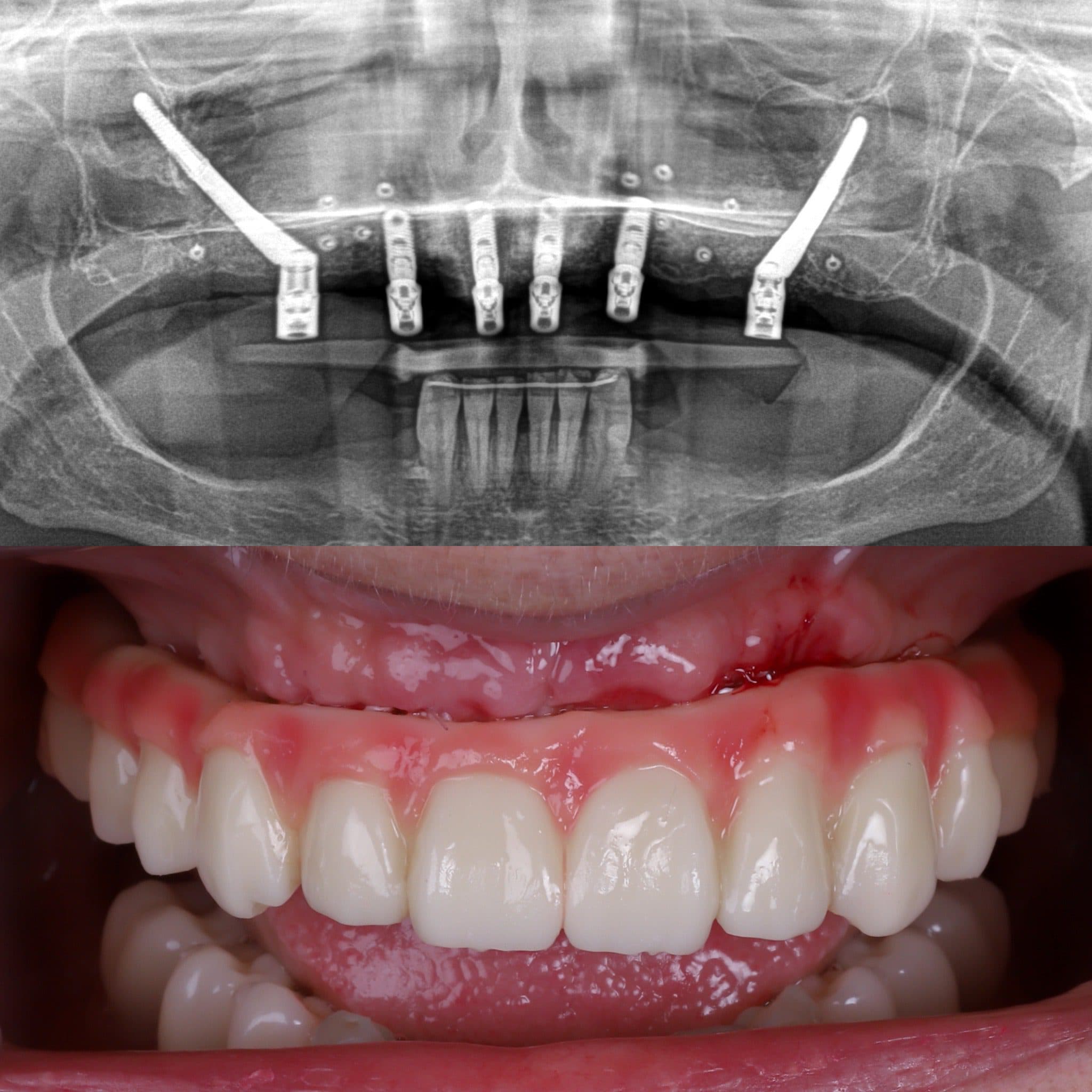 Zygomatic implant procedure