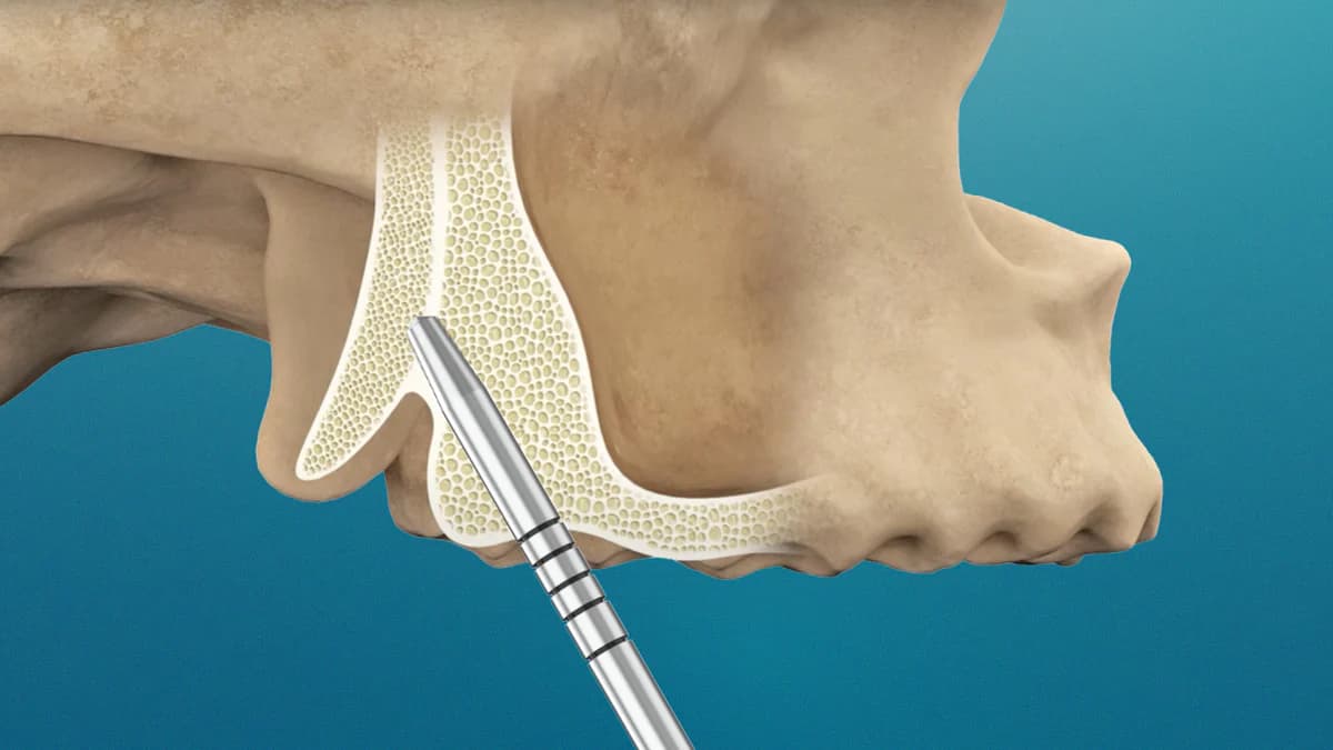 Pterygoid Implants