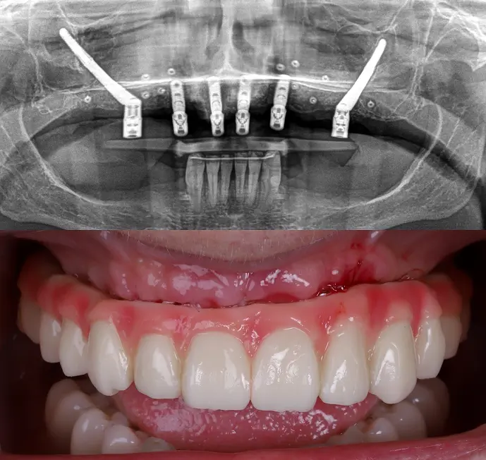 Zygomatic implants — X-ray and fixed teeth result