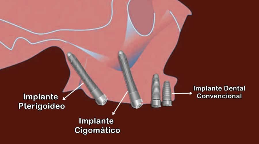 Pterygoid implant clinical view