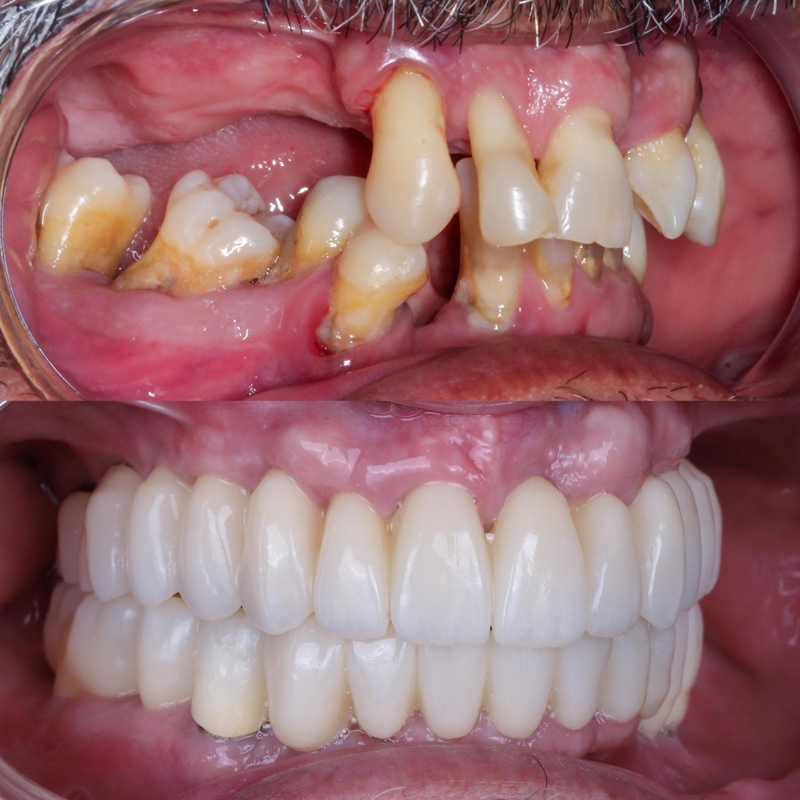 Before and after — personalized subperiosteal implants