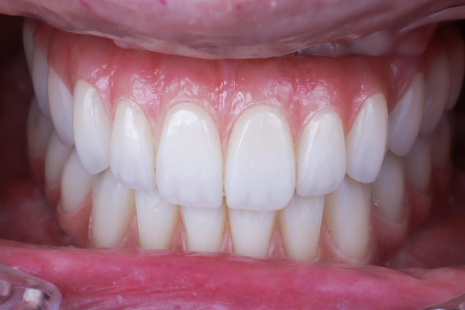 Transnasal Implants