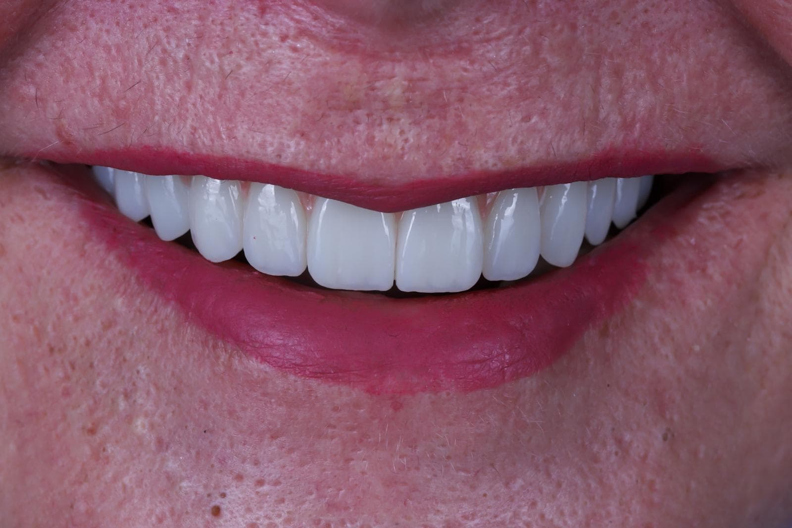 Transnasal implant procedure