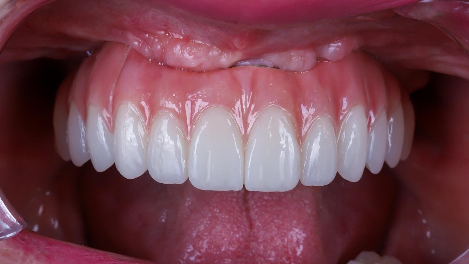 Transnasal implant result