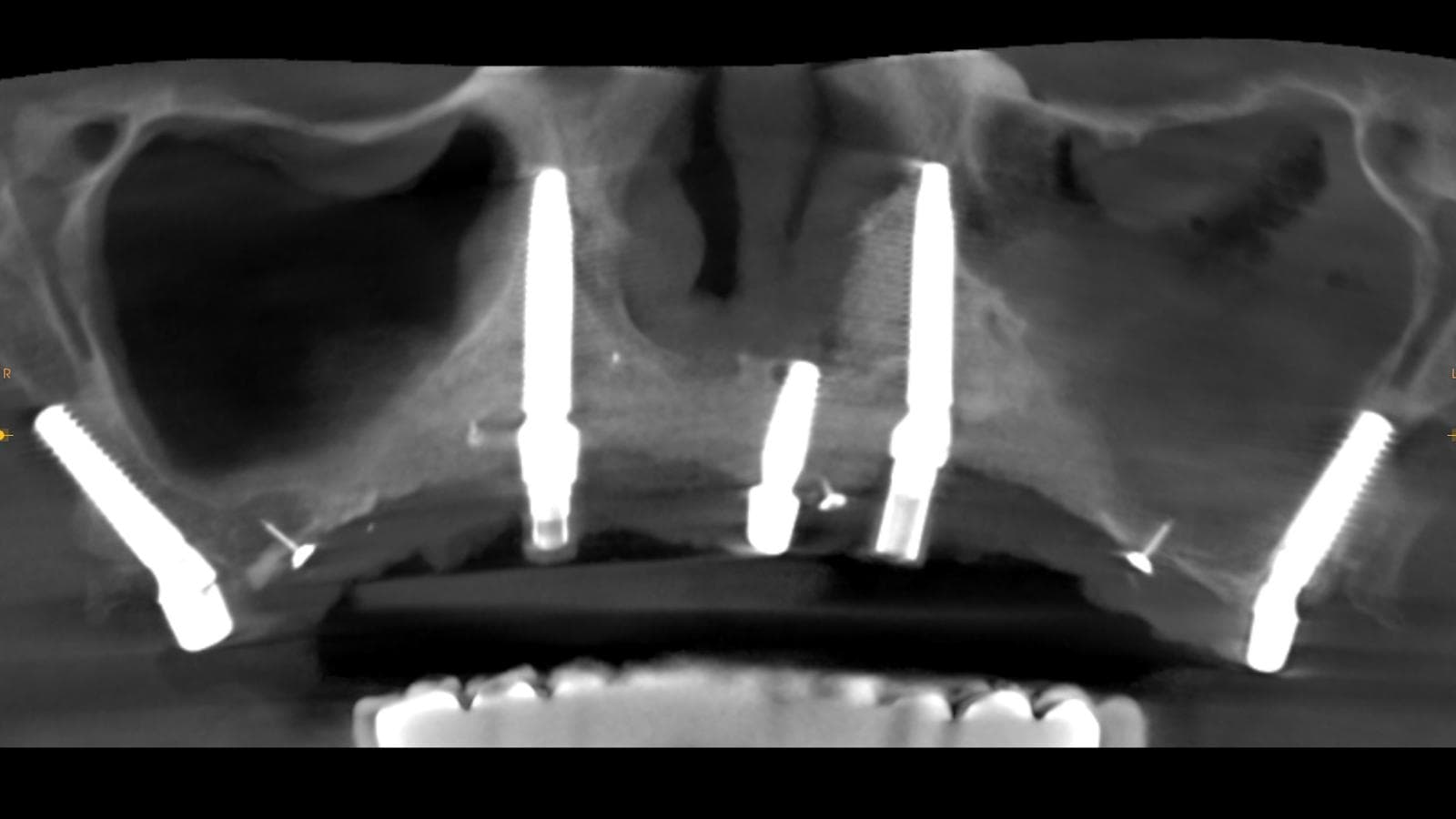 Transnasal implant treatment