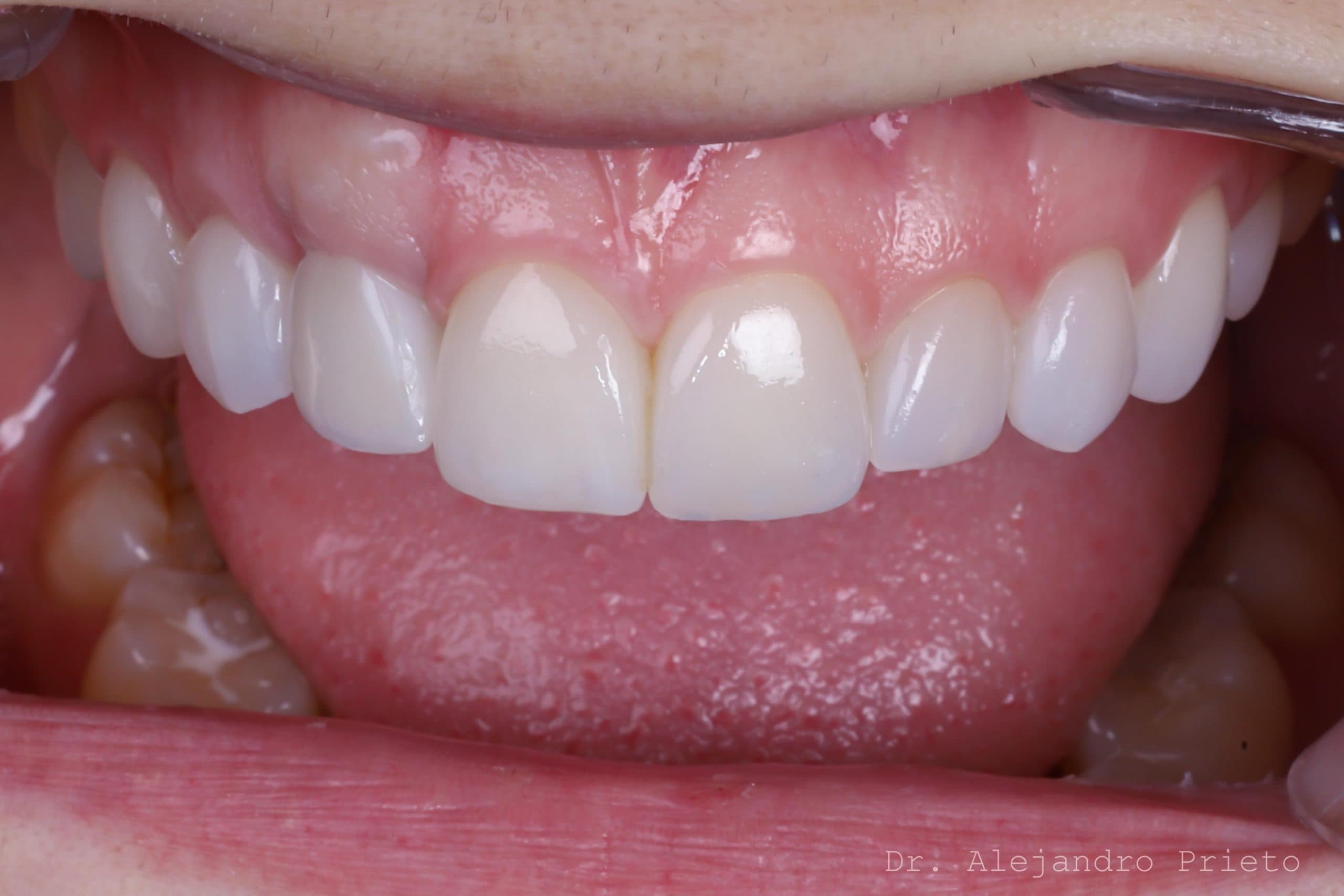 Ultra-thin no-prep veneers