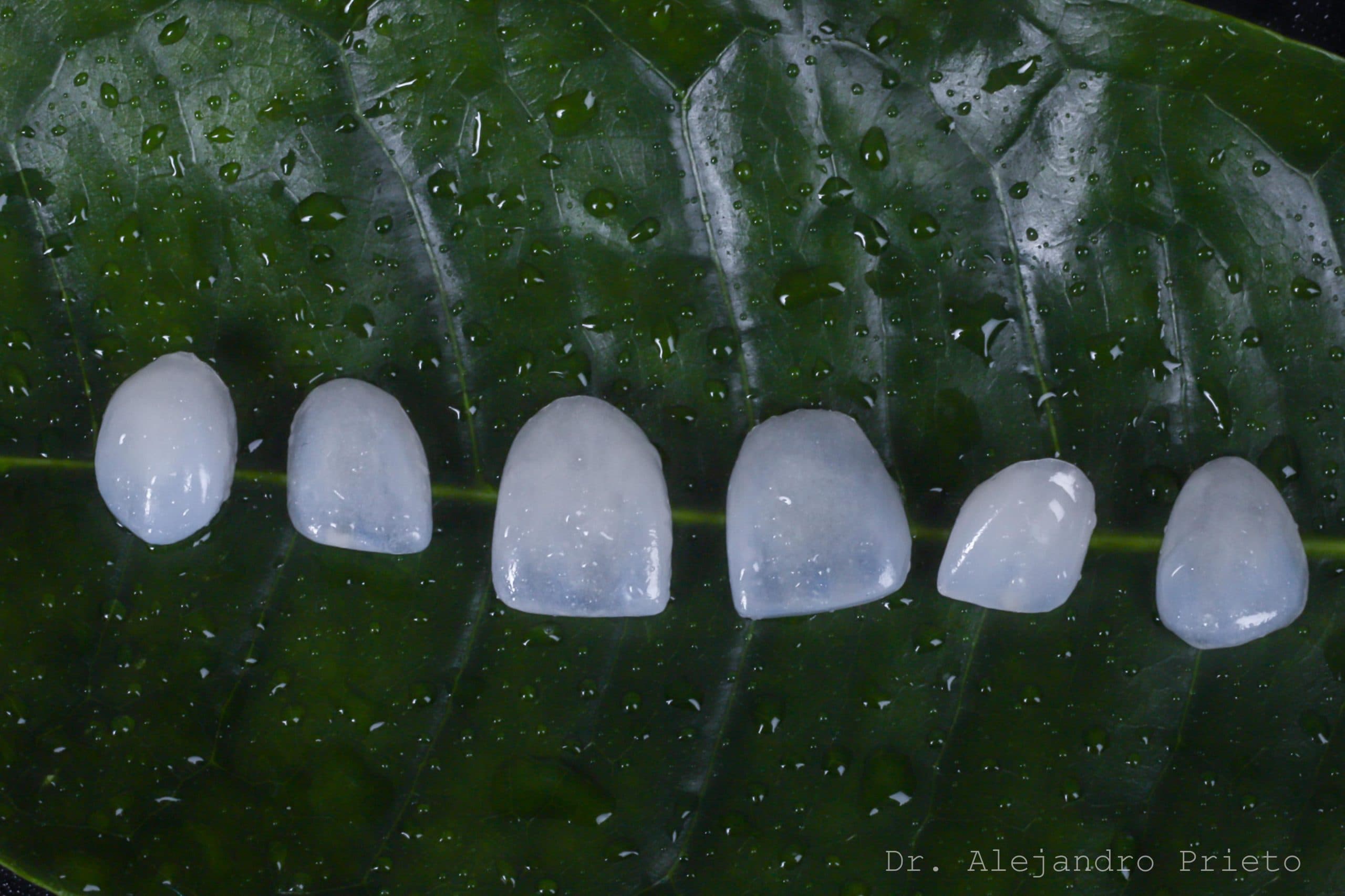 No-Prep Veneers
