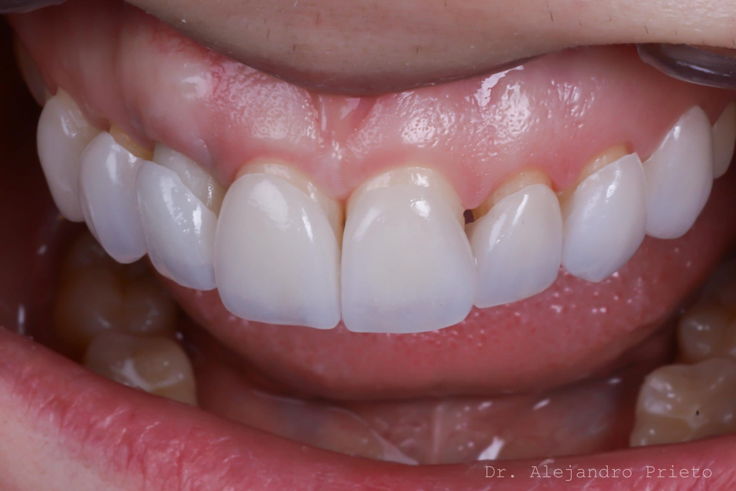 No-prep dental veneers before and after