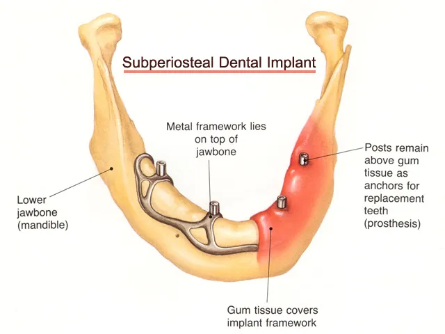 Subperiosteal dental implant diagram — framework on jawbone beneath gum tissue