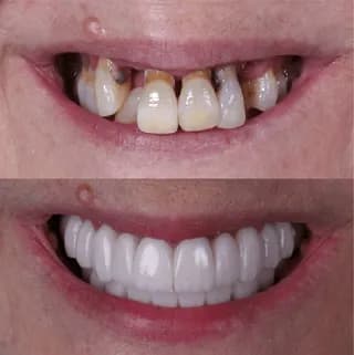 Dental implants before and after case 1