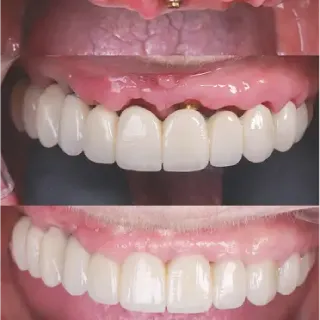 Dental implants before and after case 2