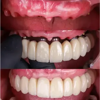 Dental implants before and after case 3