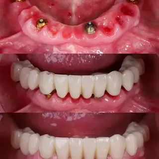 Dental implants before and after case 4