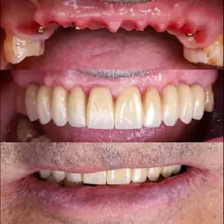 Dental implants before and after case 5