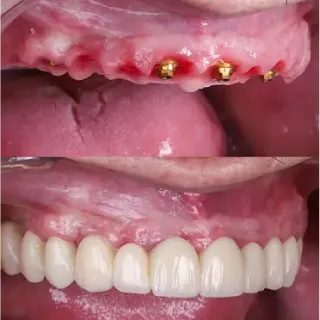 Dental implants before and after case 8