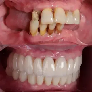 Dental implants before and after case 9