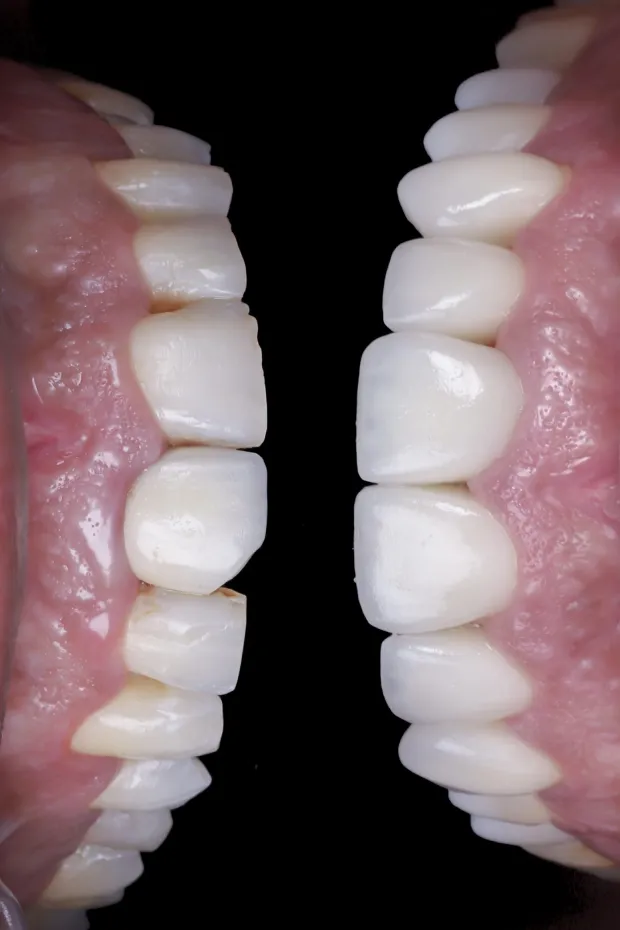 High-aesthetic veneers before and after case 1