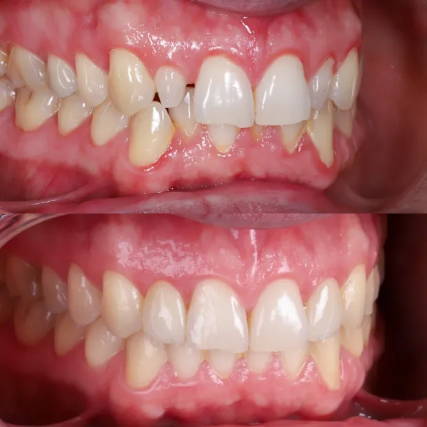 High-aesthetic veneers before and after case 10