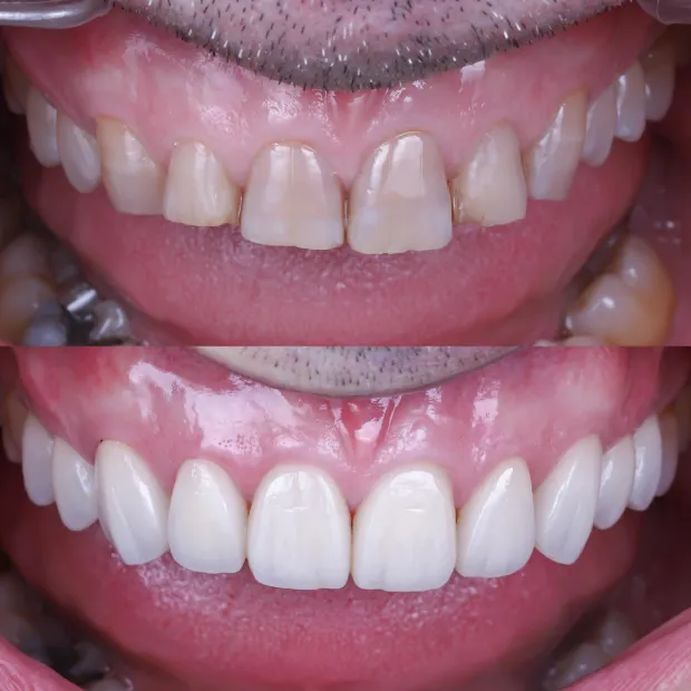 High-aesthetic veneers before and after case 2