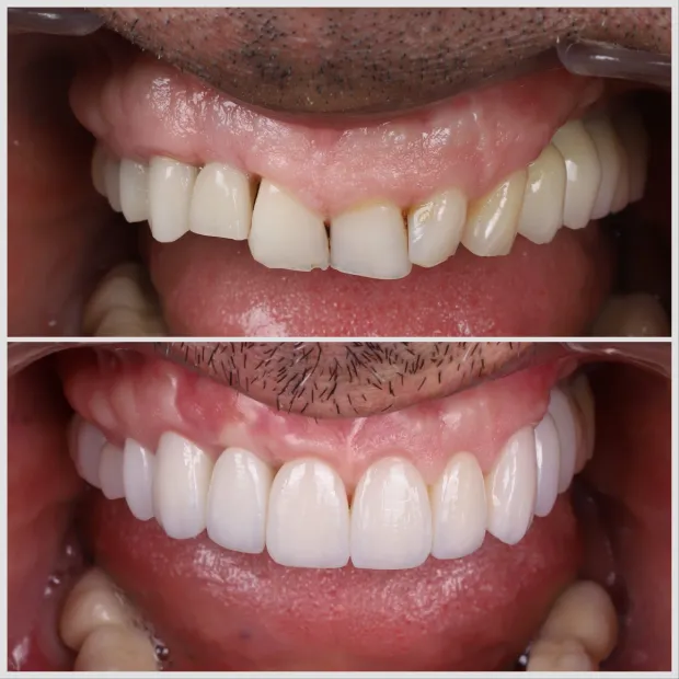 High-aesthetic veneers before and after case 3
