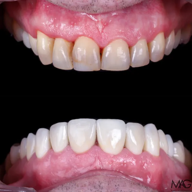 High-aesthetic veneers before and after case 4