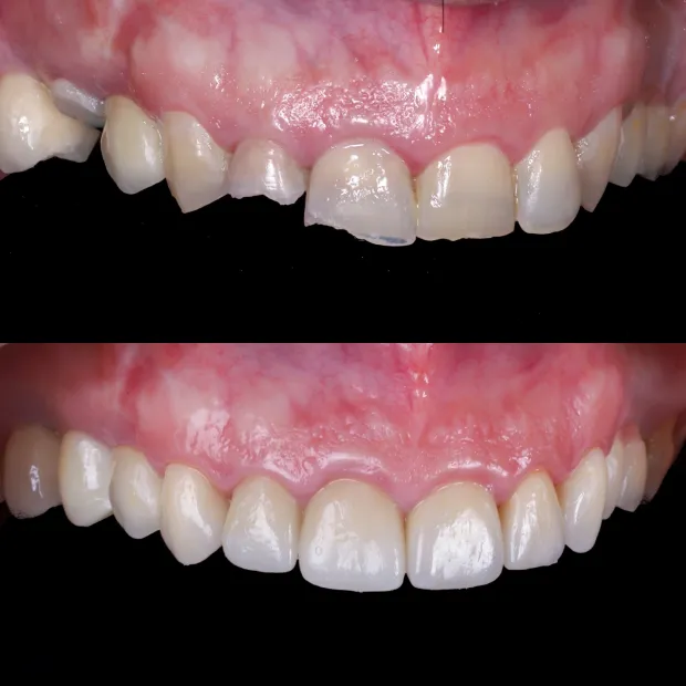 High-aesthetic veneers before and after case 5