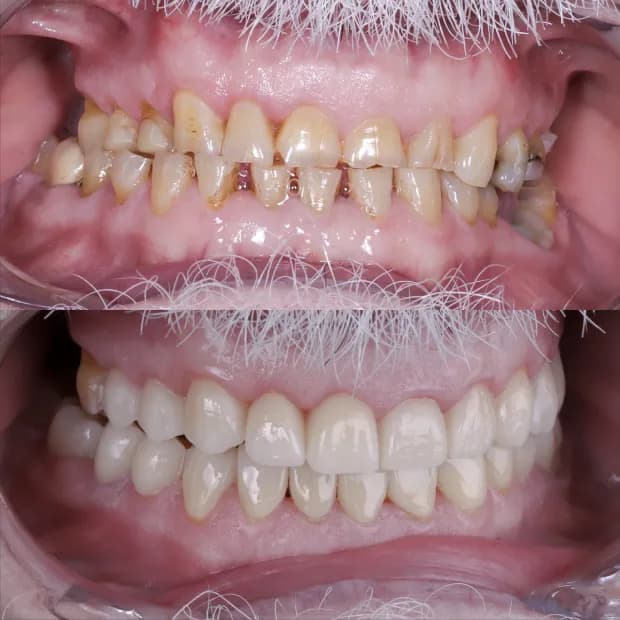 High-aesthetic veneers before and after case 7