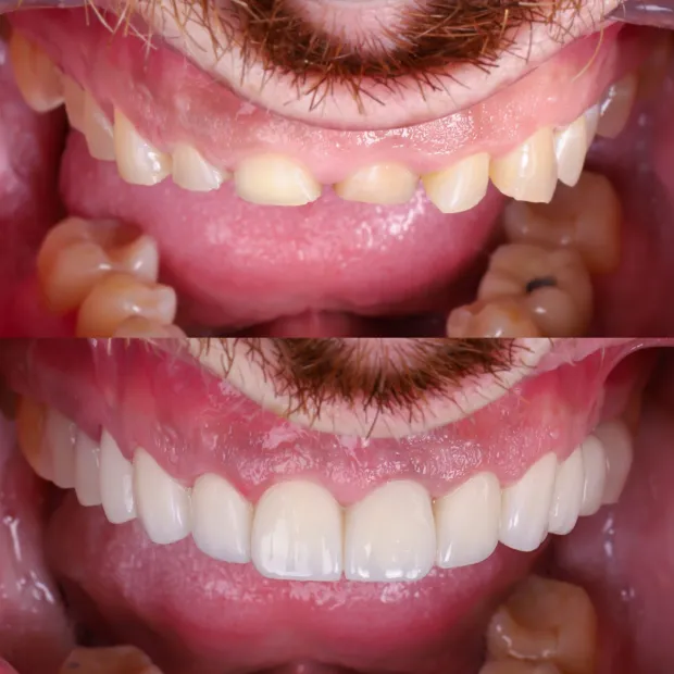 High-aesthetic veneers before and after case 8