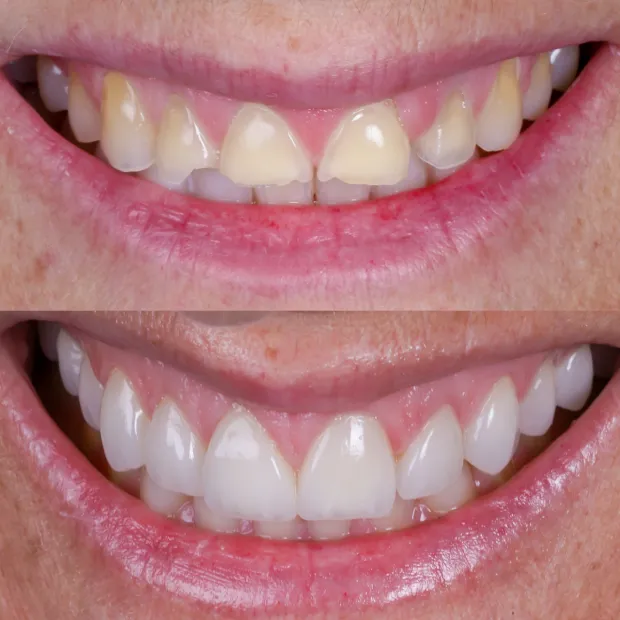 High-aesthetic veneers before and after case 9