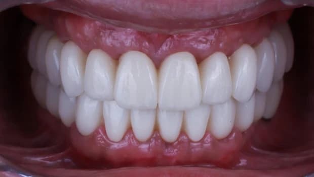 Immediate loading implant treatment 3