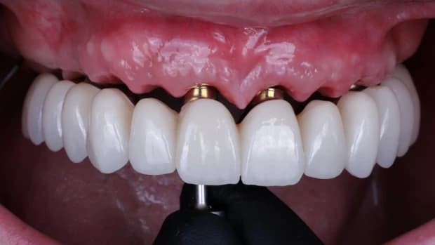 Immediate loading implant treatment 2