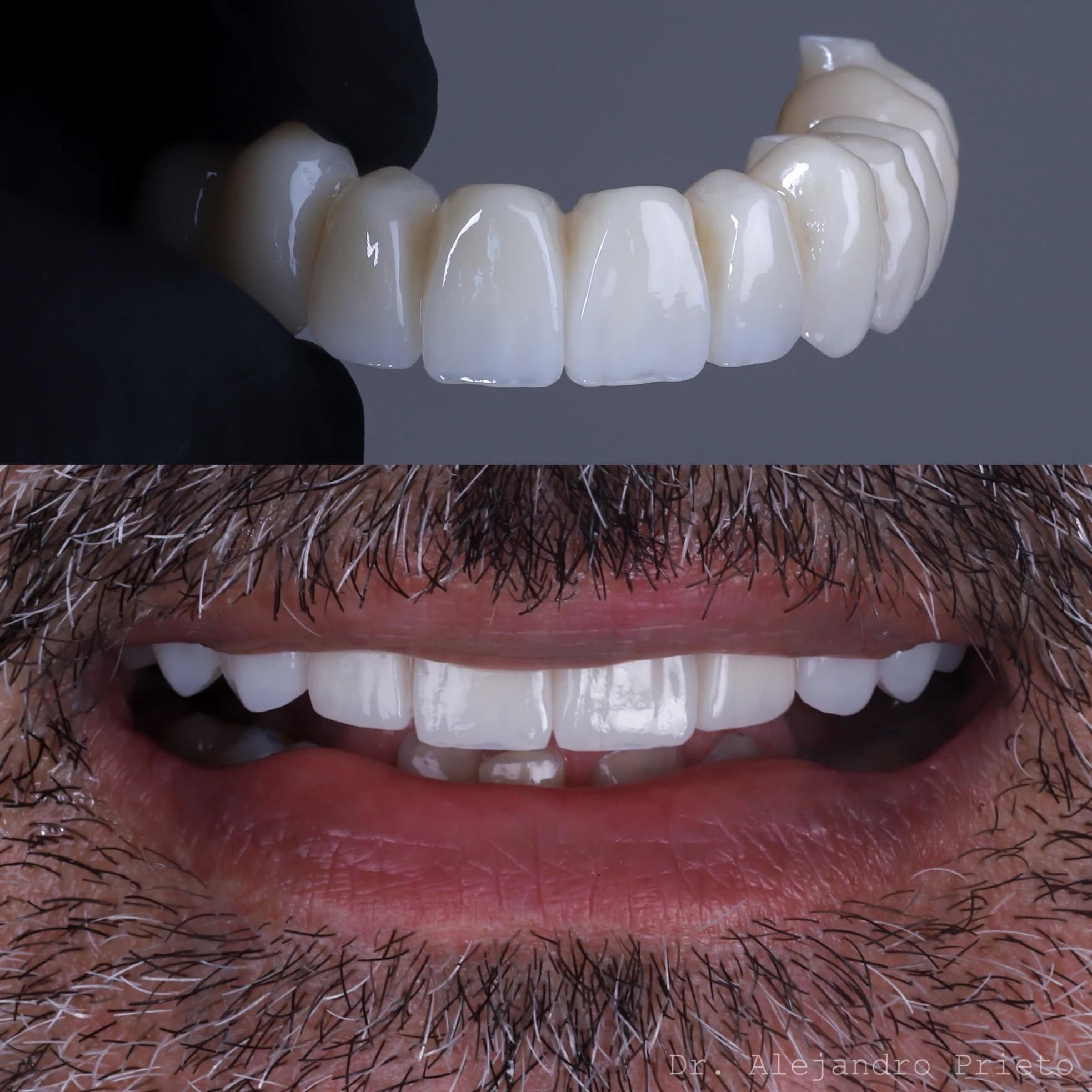 Immediate Loading Implants