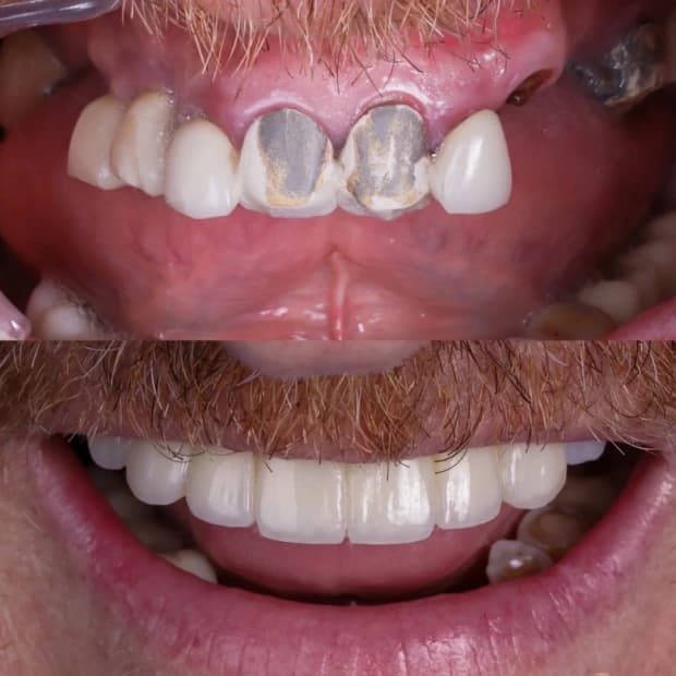 Zygomatic implant treatment