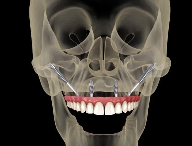 Zygomatic implant procedure