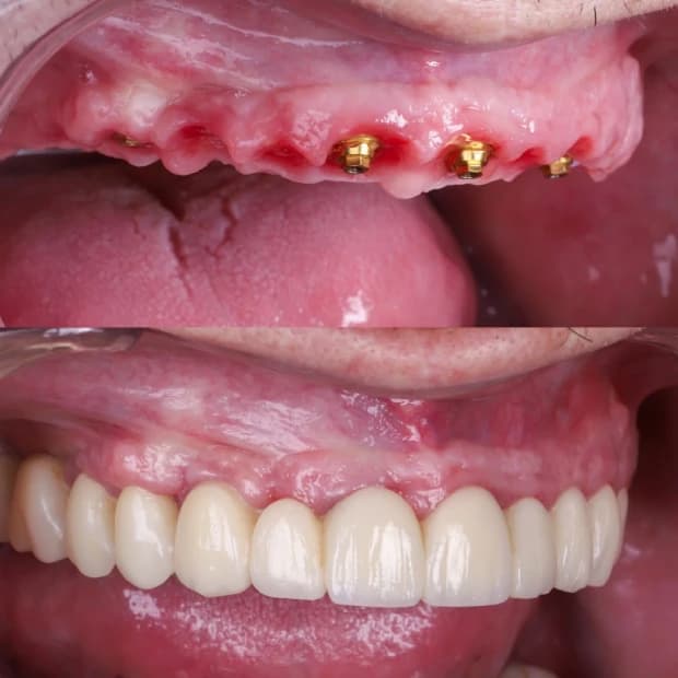Zygomatic implant result
