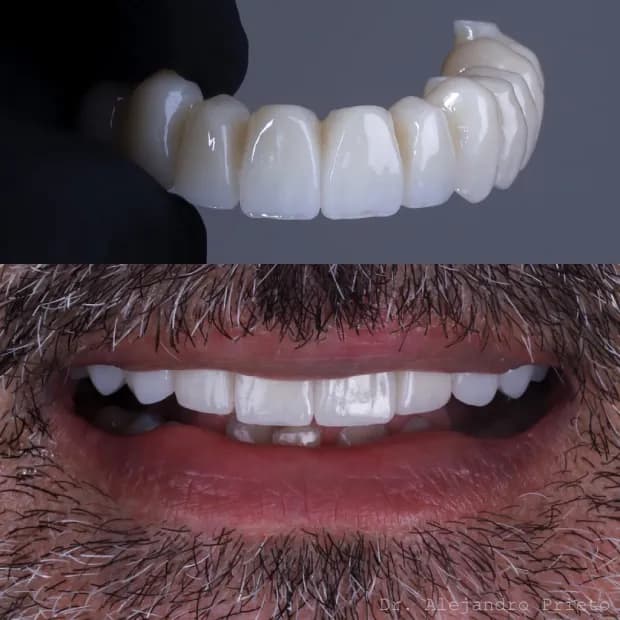 Fixed denture on dental implants