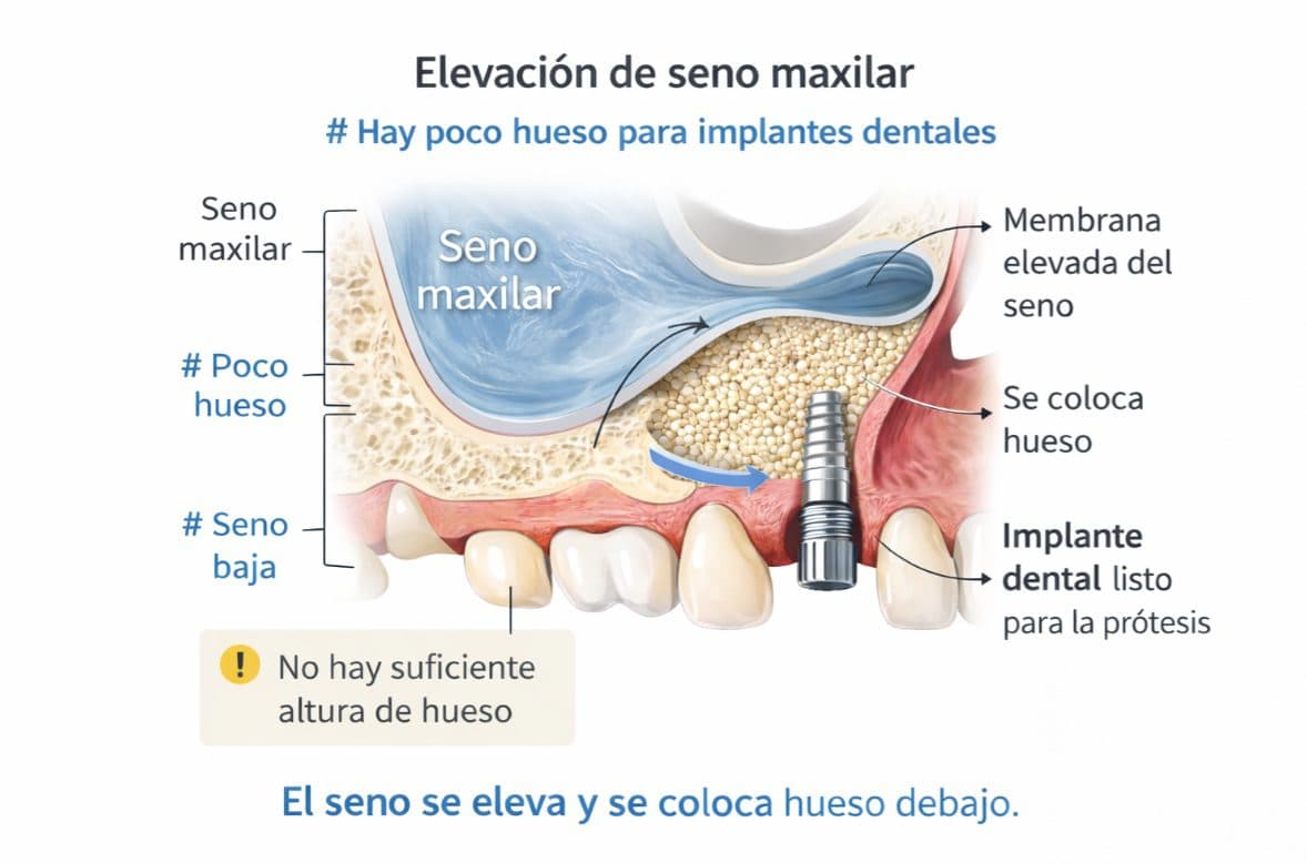 Maxillary Sinus Lift: Dental Implants When There Is No Bone