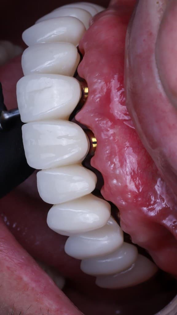 Fixed dental bridge on implants — clinical close-up