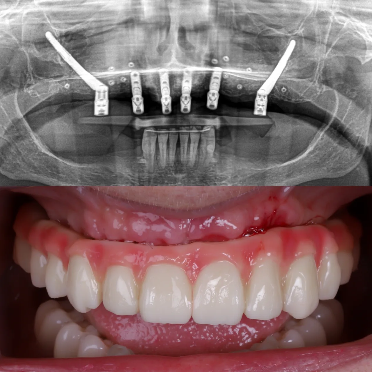 Zygomatic Implants