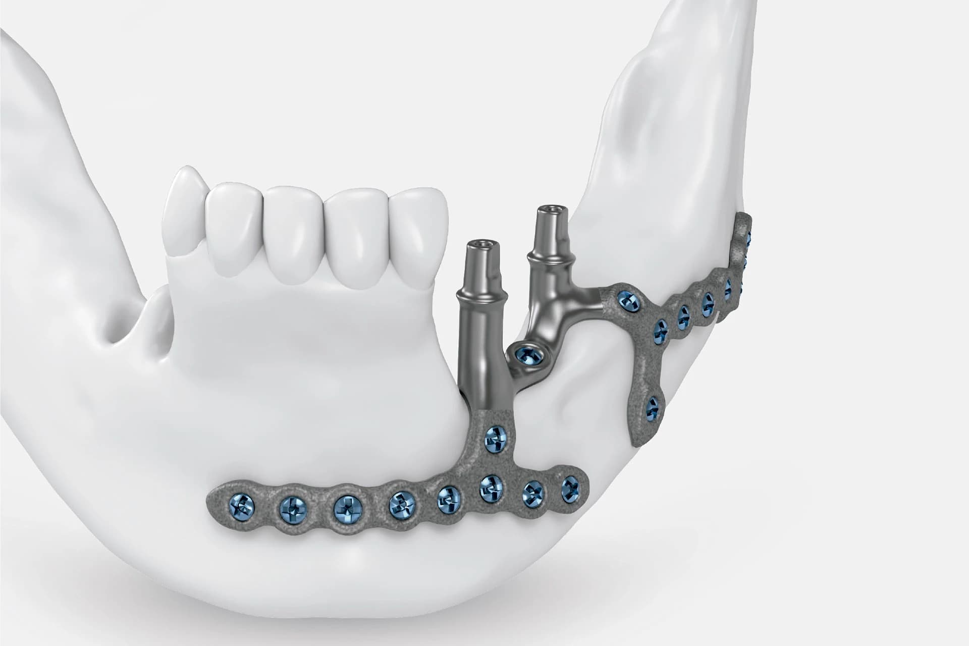 3D design of subperiosteal dental implant