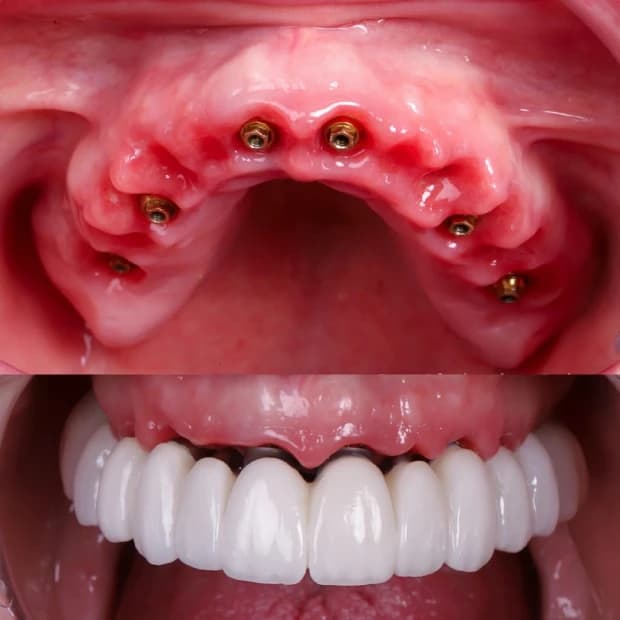 Immediate loading implant process