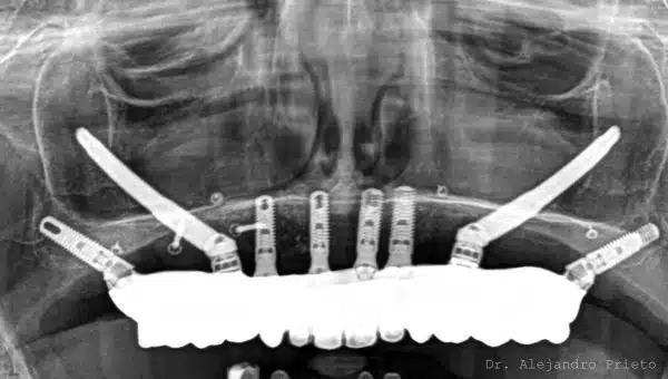 Pterygoid implants case radiography