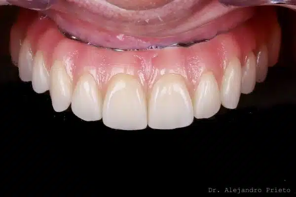 Pterygoid implants final aesthetic result